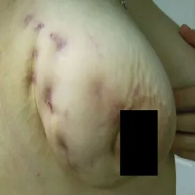 Zmiany skórne na piersi choroba promienica