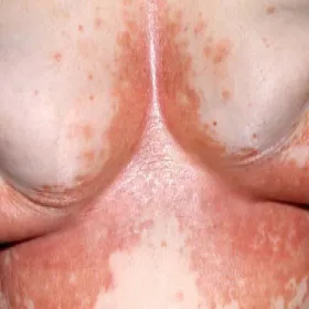 Zmiany skórne na piersiach zdjęcia łupież rumieniowy 