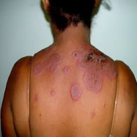 Zmiany skórne na plecach rumień wielopostaciowy 