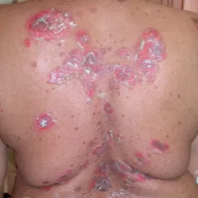 Zmiany skórne na plecach zdjęcia pęcherzyca zwykła