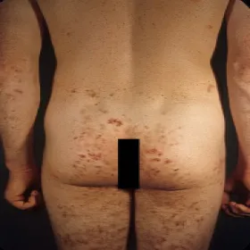 Zmiany skórne na pośladkach choroba Duhringa