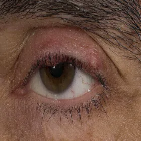 Zmiany skórne na powiekach zapalenie mieszków włosowych