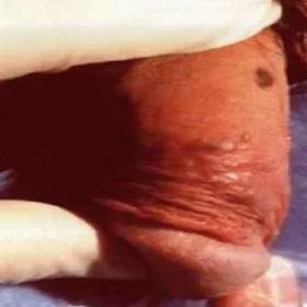 Zmiany skórne na prąciu grudkowatość bowenoidalna 