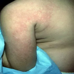 Zmiany skórne na ramieniu rumień zakaźny