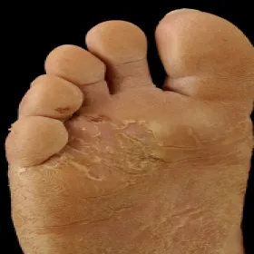 Zmiany skórne na stopach hiperkeratoza