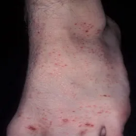 Zmiany skórne na stopach liszaj czerwony