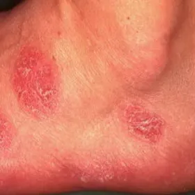 Zmiany skórne na stopie wyprysk pieniążkowaty