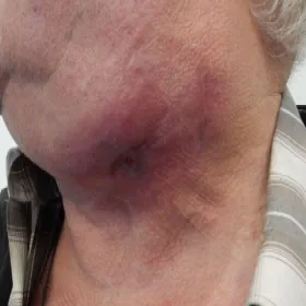 Zmiany skórne na szyi choroba promienica