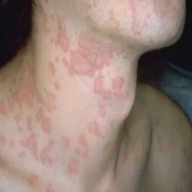 Zmiany skórne na szyi rumień wielopostaciowy 