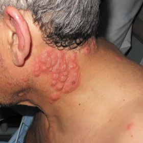 Zmiany skórne na szyi zespół Sweeta