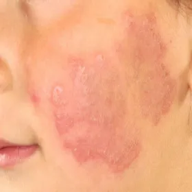 Zmiany skórne na twarzy w toczniu zdjęcia