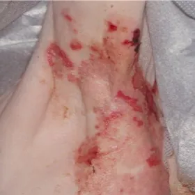 Zmiany skórne pod pachą zdjęcia pęcherzyca zwykła