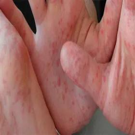 Zmiany skórne pojawiające się w przebiegu bostonki 