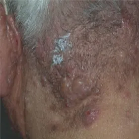 Zmiany skórne trądzik skupiony 