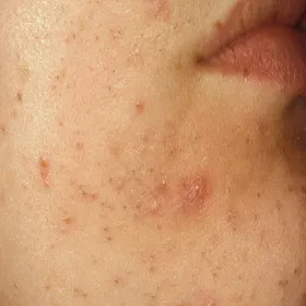 Zmiany skórne twarzy zdjęcia zaskórniki otwarte