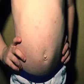 Zmiany skórne u dzieci na brzuchu choroba przyłuszczyca