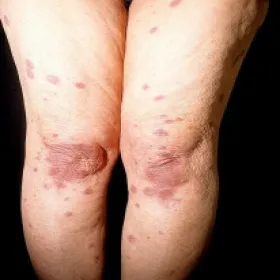 Zmiany skórne w zespole Sweeta na nogach