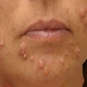 Zmiany skórne w zespole Sweeta na twarzy