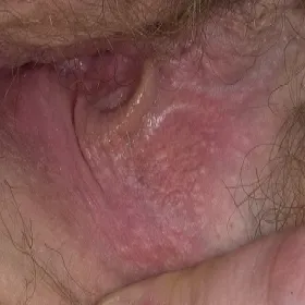 Zmiany skórne warg sromowych choroba Foxa-Fordyce'a