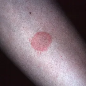 Zmiany skórne wyprysk mikrobowy