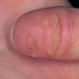 Zmiany skórne zdjęcia na palcu kurzajki