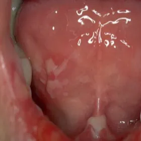 Zmiany w jamie ustnej zdjęcia pęcherzyca zwykła