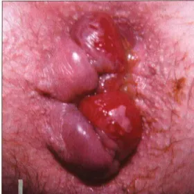 Zmiany w okolicy odbytu hemoroidy