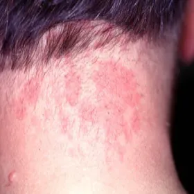 Znamię naczyniowe płaskie uszczypnięcie bociana