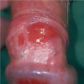 Zoon's balanitis