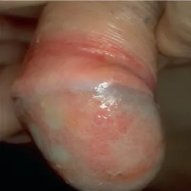  Zoon's erythroplasia