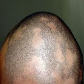 alopecia areata