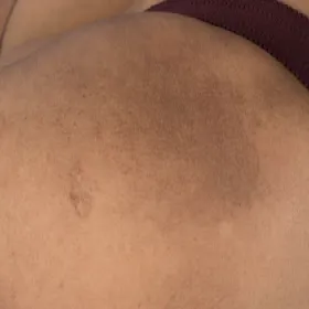 amyloidozy skóry na nodze