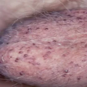 angiokeratoma na mosznie