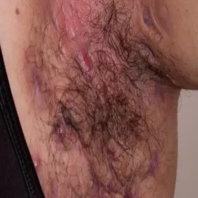 ból pod pachą ropne zapalenie apokrynowych gruczołów potowych