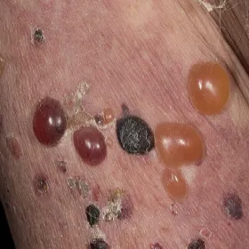 bąble na skórze jak po oparzeniu