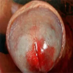 balanitis of Zoon