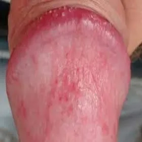 balanitis zapalenie żołędzi