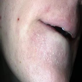 białe grudki na brodzie zaskórniki zamknięte