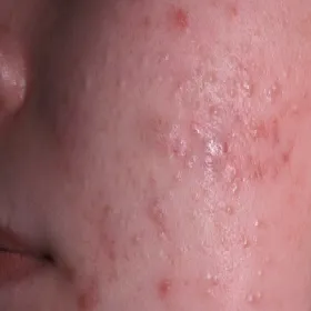 białe grudki na policzkach zaskórniki zamknięte