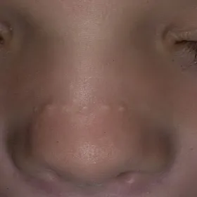 białe krostki na nosie zaskórniki