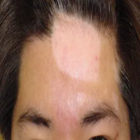 białe plamy na czole