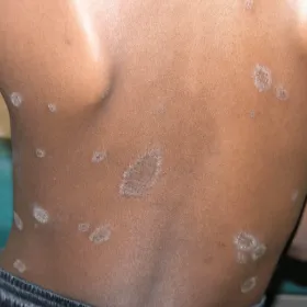 blaszka macierzysta łupież różowy