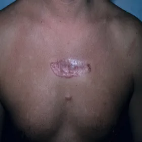 bliznowce na klatce piersiowej