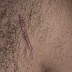 bliznowiec samoistny