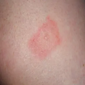 borelioza objawy skórne zdjęcia