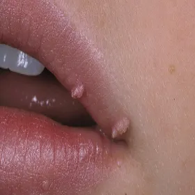 brodawka na ustach