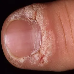 brodawka na wale paznokciowym