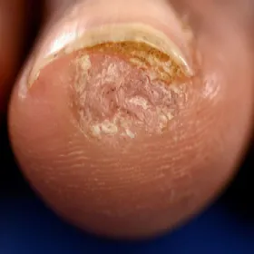 brodawka podpaznokciowa