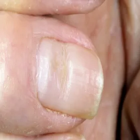 bruzdy na paznokciu zdjęcie