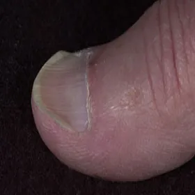 chore paznokcie paznokcie wklęsłe